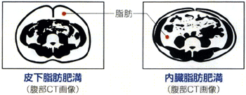 皮下脂肪肥満と内臓脂肪肥満